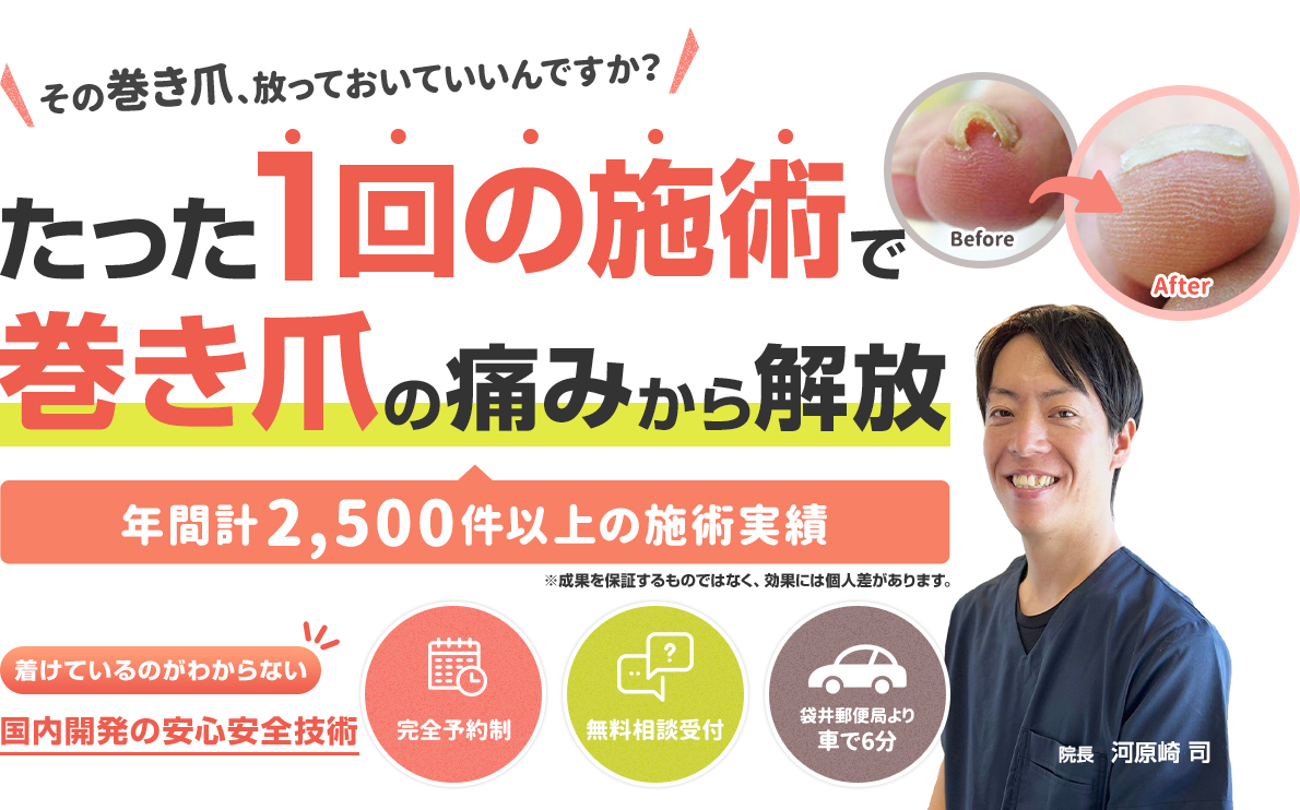 たった1回の施術で巻き爪の痛みから解放