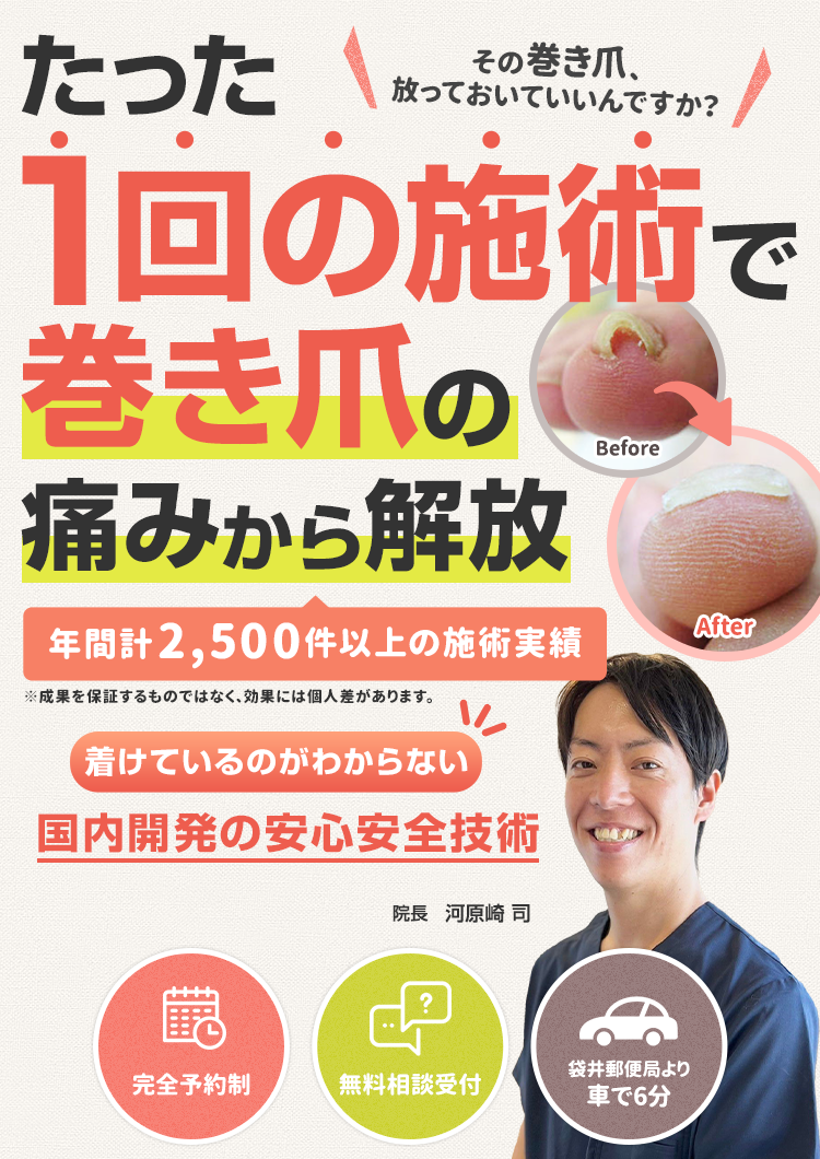 たった1回の施術で巻き爪の痛みから解放